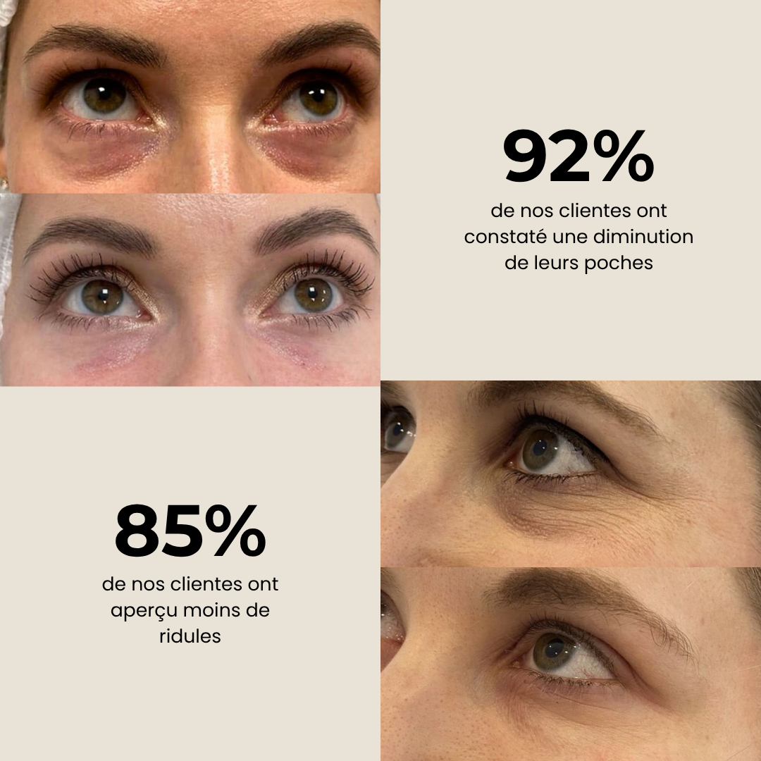 Patchs Anti-Cernes au Charbon de Bambou